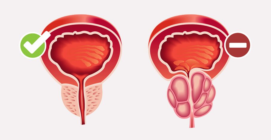 Prostamin Forte простата өлшемі мен қызметін қалыпқа келтіреді